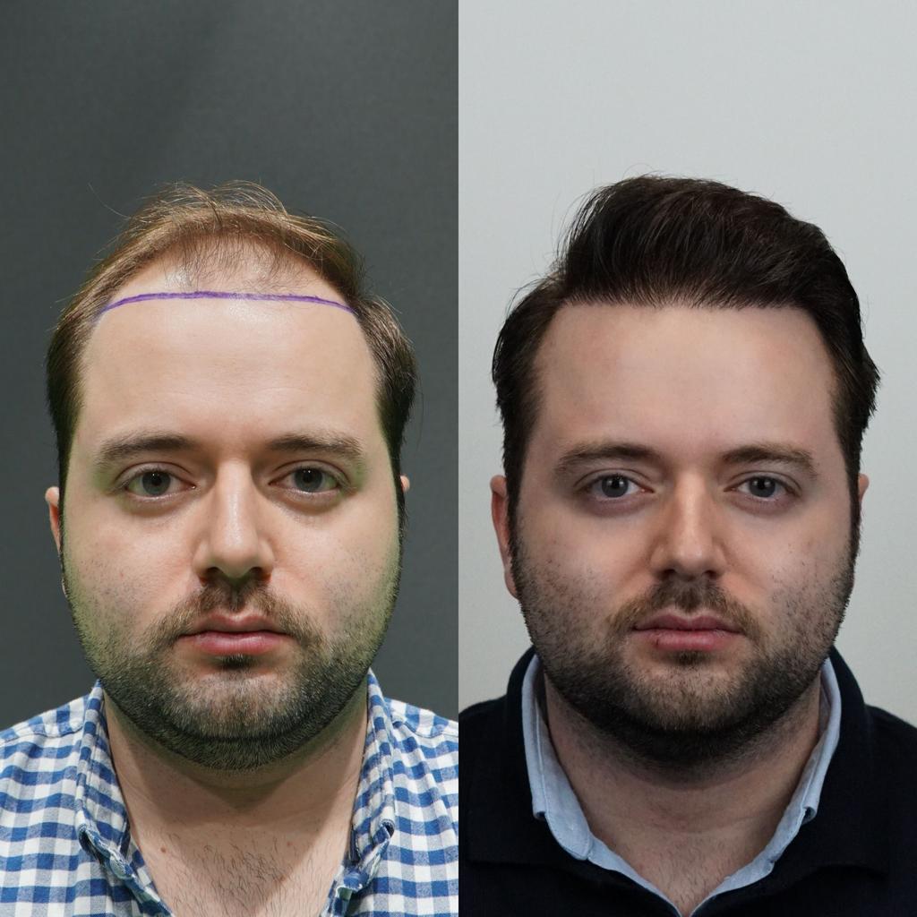 prima e dopo trapianto capelli 3